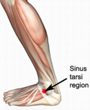 Sinus Tarsi Syndrome